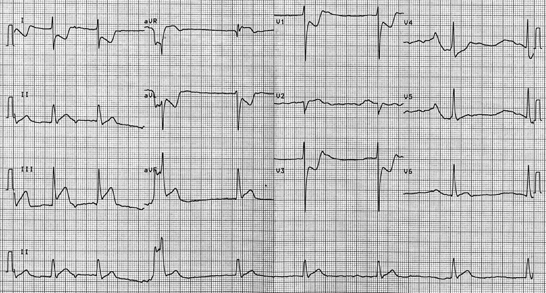 Atrial fibrillation and inferior-posterior myocardial infarction.