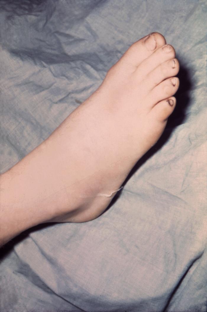 The foot of this patient is swollen due to gonococcal arthritis. Gonorrhea is the most frequently reported communicable disease in the U.S. Disseminated gonococcal infection is most often the cause of acute septic arthritis in sexually active adults, and the reason for most hospitalizations due to infective arthritis. Adapted from CDC