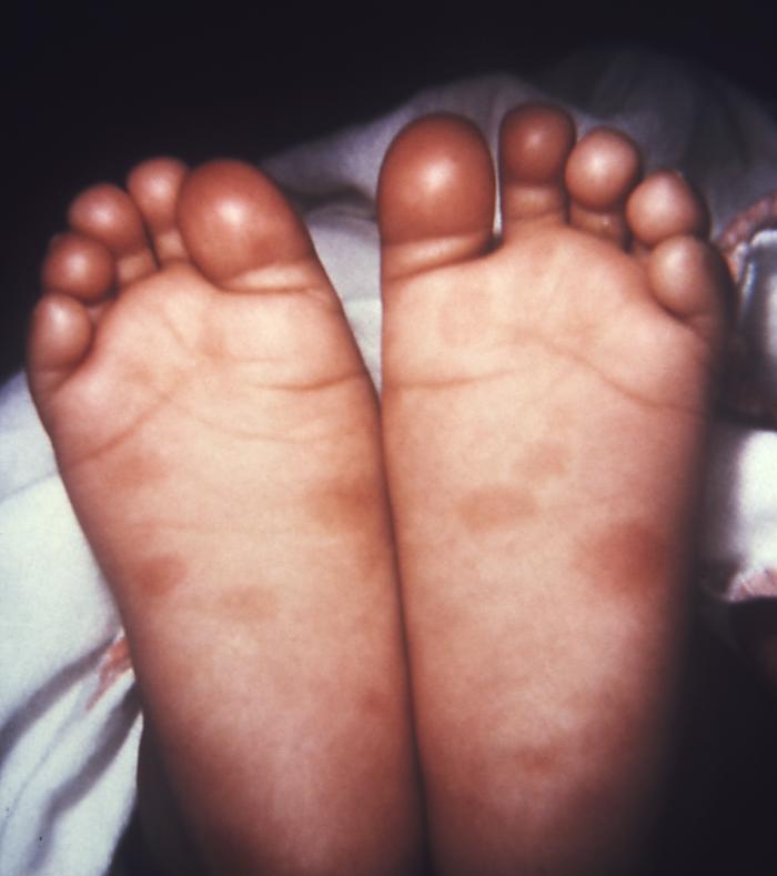 This newborn presented with symptoms of congenital syphilis that included lesions on the soles of both feet. If not treated immediately, an infected baby may be born without symptoms, but can develop them within a few weeks. These signs and symptoms can be very serious. Untreated babies may become developmentally delayed, have seizures, or die. Adapted from CDC