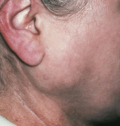 SALIVARY GLANDS: MIXED TUMOR OF PAROTID. The pre-auricular mass had enlarged to this size over a period of 5 years.(Courtesy of Dr. Charles E. Tomich, Indianapolis, IN.)
