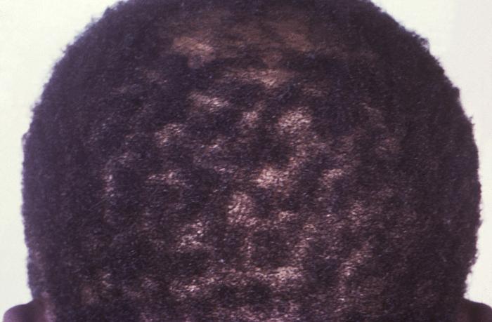 This image depicts the posterior scalp of a patient, who’d presented with what was described as “motheaten” alopecia, due to what was diagnosed as secondary syphilis. The secondary stage of syphilis is characterized by the manifestation of a skin rash and mucous membrane lesions. This stage typically starts with the development of a rash on one or more areas of the body. The rash usually does not cause itching. Rashes associated with secondary syphilis can appear as the chancre is healing or several weeks after the chancre has healed. The characteristic rash of secondary syphilis may appear as rough, red, or reddish brown spots both on the palms of the hands and the bottoms of the feet. However, rashes with a different appearance may occur on other parts of the body, sometimes resembling rashes caused by other diseases. Sometimes rashes associated with secondary syphilis are so faint that they are not noticed. In addition to rashes, symptoms of secondary syphilis may include fever, swollen lymph glands, sore throat, patchy hair loss, headaches, weight loss, muscle aches, and fatigue. The signs and symptoms of secondary syphilis will resolve with or without treatment, but without treatment, the infection will progress to the latent and possibly late stages of disease. Adapted from CDC