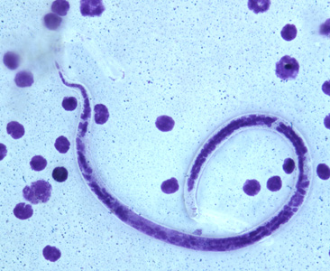 Microfilaria of B. timori in a thick blood smear from a patient from Indonesia, stained with Giemsa and captured at 500x oil magnification. Image from a specimen courtesy of Dr. Thomas C. Orihel, Tulane University, New Orleans, LA. Adapted from CDC