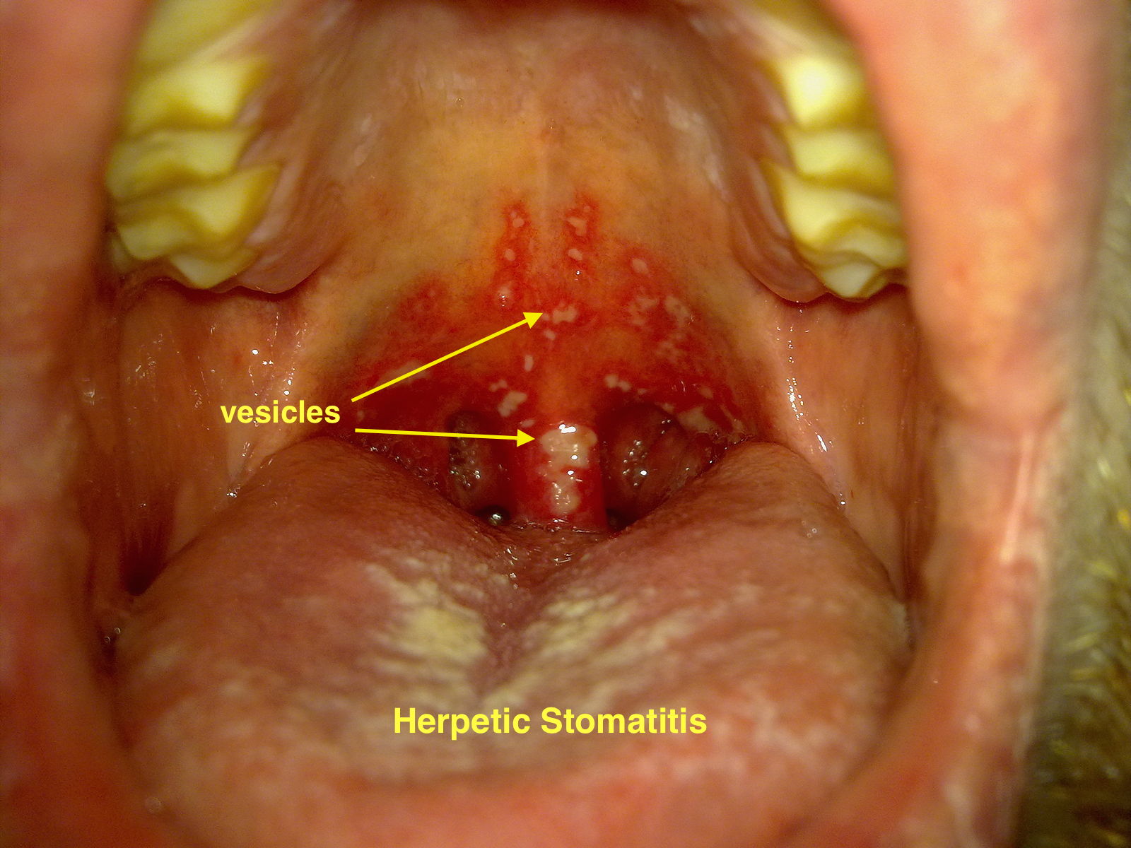 Herpetic stomatitis[28]
