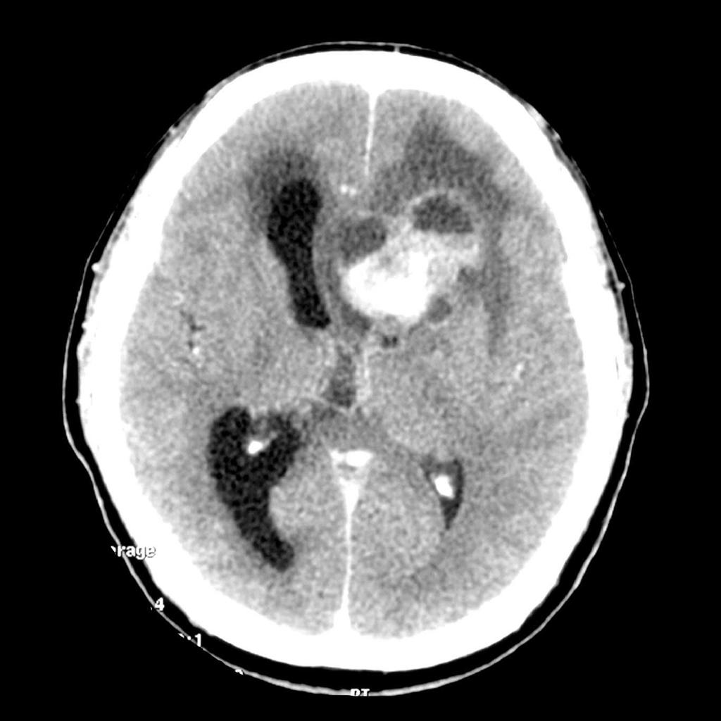 File:Ependymoma-lateral-ventricle(1).jpg