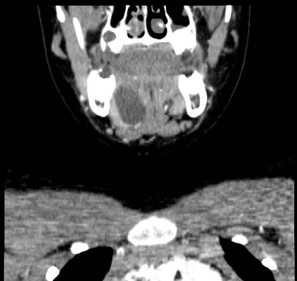 CT demonstrates a Ranula Image courtesy of RadsWiki and copylefted