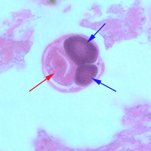 Higher magnification (1000x oil) of a female of S. stercoralis from the same specimen as Figure 1. Notice the intestine (red arrow) and ovaries (blue arrows). Adapted from CDC