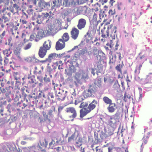 Sections of S. stercoralis from a duodenal biopsy specimen, stained with H&E. Although strongyloidiasis could not be confirmed based on microscopy alone, this case was confirmed using molecular methods (PCR). Image taken at 200x magnification. Adapted from CDC