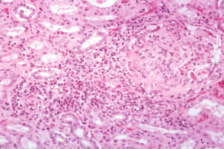 Kidney: Lupus Erythematosus: Micro med mag H&E typical glomerulonephritis lesion