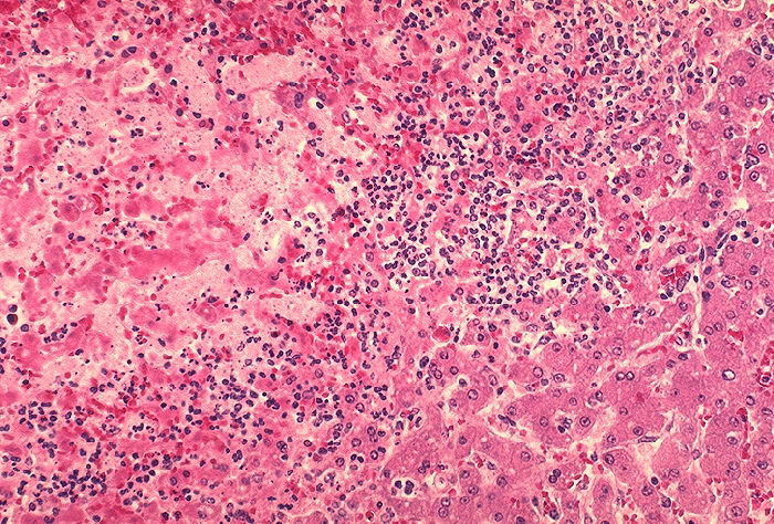 Histopathology of liver in fatal human plague. Focal hepatocellular necrosis adjacent to thrombosis. Adapted from Public Health Image Library (PHIL), Centers for Disease Control and Prevention.[15]