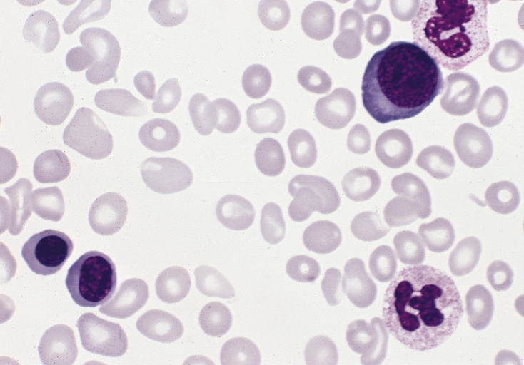 File:Polycythemia vera, blood smear.jpg