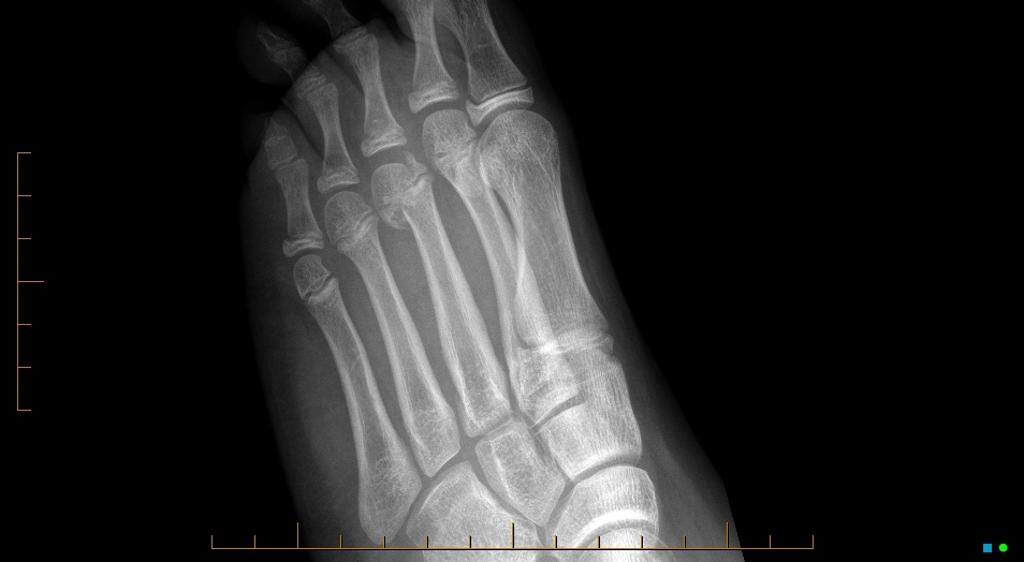 File:Salter-Harris type IV injury of foot.jpg