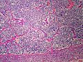 File:120px-Adrenal Neuroblastoma MP PA.JPG