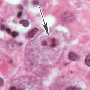 A single trophozoite (black arrow) of B. mandrillaris in brain tissue, stained with H&E. Adapted from CDC