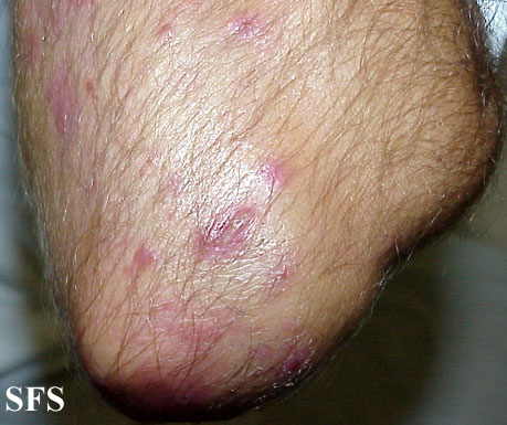 File:Dermatitis herpetiformis21.jpg