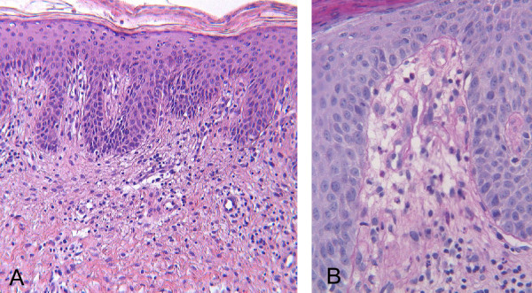 A) Psoriasiform hyperplasia of the epidermis with overlying parakeratosis and mild perivascular infiltrate of lymphocytes in the upper dermis (HE 5 X). B) Vascular dilatation (HE 20 X).[11]