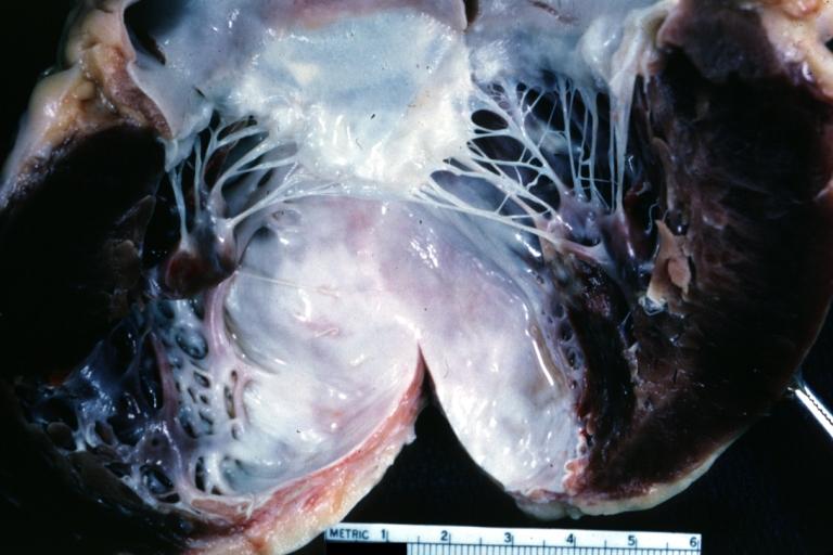 Left ventricular aneurysm pathophysiology - wikidoc