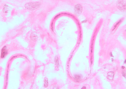 Microfilariae of O. volvulus from a skin nodule of a patient from Zambia, stained with H&E. Image taken at 1000x oil magnification. Adapted from CDC
