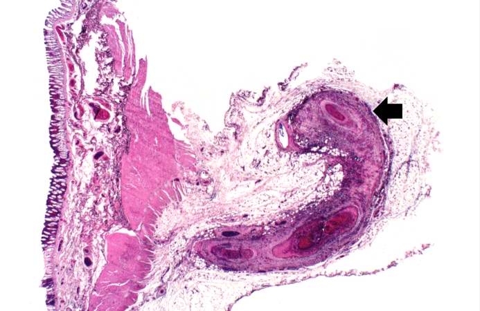 This is a low-power photomicrograph of a mesenteric vessel from this case of polyarteritis nodosa (arrow). The vessel is completely occluded by thrombotic material and the vessel wall is infiltrated with inflammatory cells.