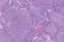 Micrograph of a follicular lymphoma, showing the characteristically abnormal lymphoid follicles. H&E stain