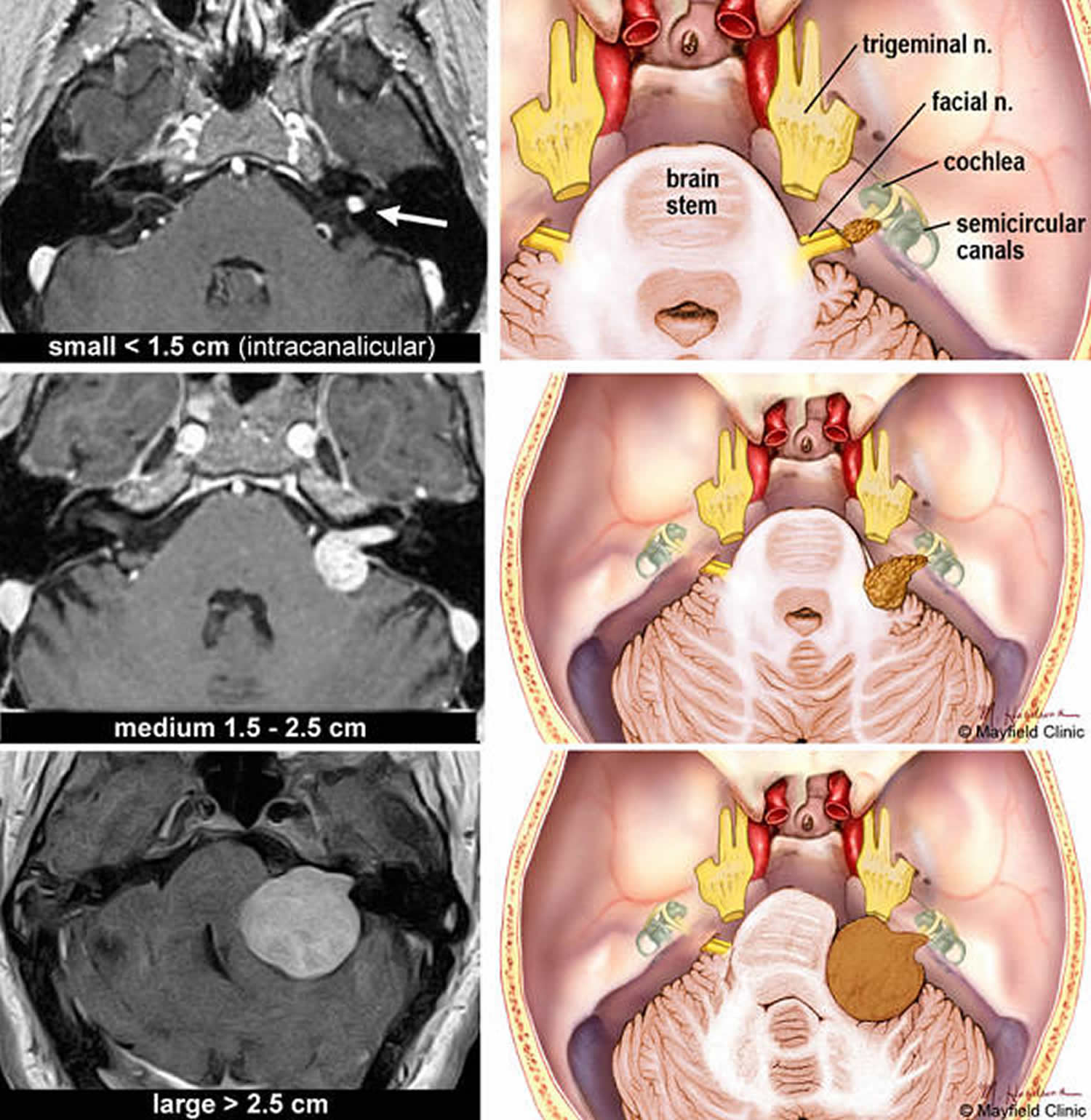Entirely intracanalicular (top) Intracranial extension without brainstem distortion (middle) Intracranial extension with brainstem distortion (bottom)