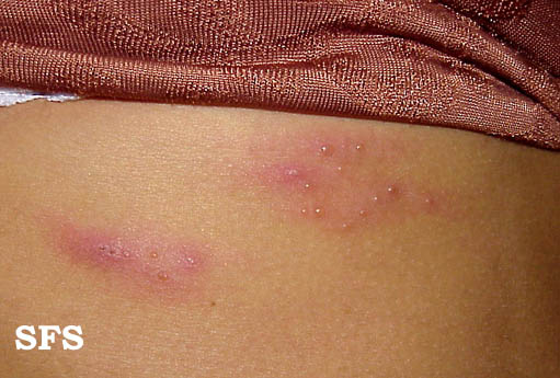 File:Herpes zoster 07.jpeg