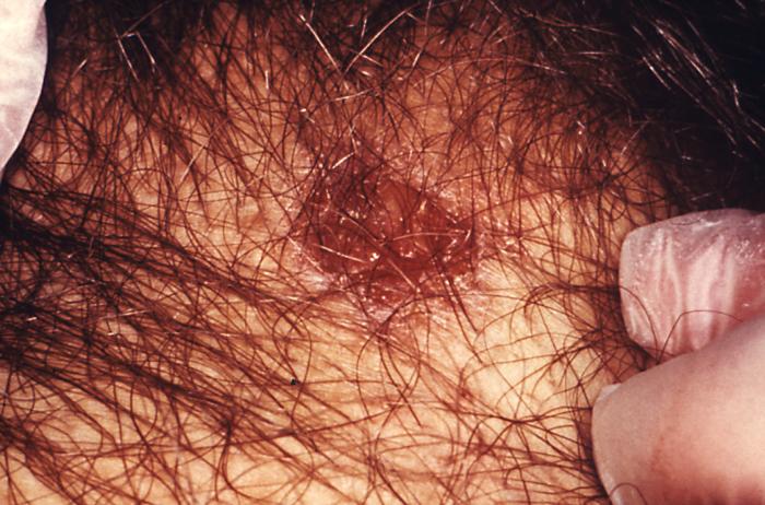 This patient presented with a primary syphilitic chancre in the right inguinal region. The primary stage of syphilis is usually marked by the appearance of a single sore known as a chancre, but there may be multiple sores. The chancre is usually firm, round, small, and painless. Adapted from CDC