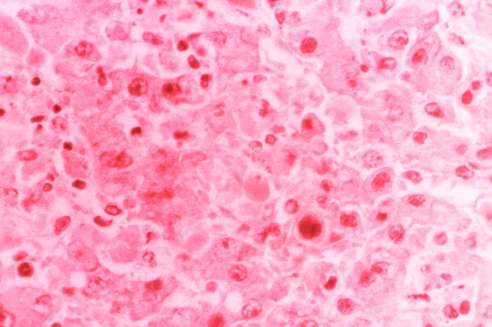 This transmission electron micrograph (TEM) demonstrates the cytoarchitectural changes of a liver tissue specimen extracted from a patient with Lassa fever. The presence of a typical Councilman body, pycnotic nuclei in an area of acidophilic necrosis, and microvacuolar fatty changes are noted.Retrieved from the Public Health Image Library (PHIL), Centers for Disease Control and Prevention.[10]