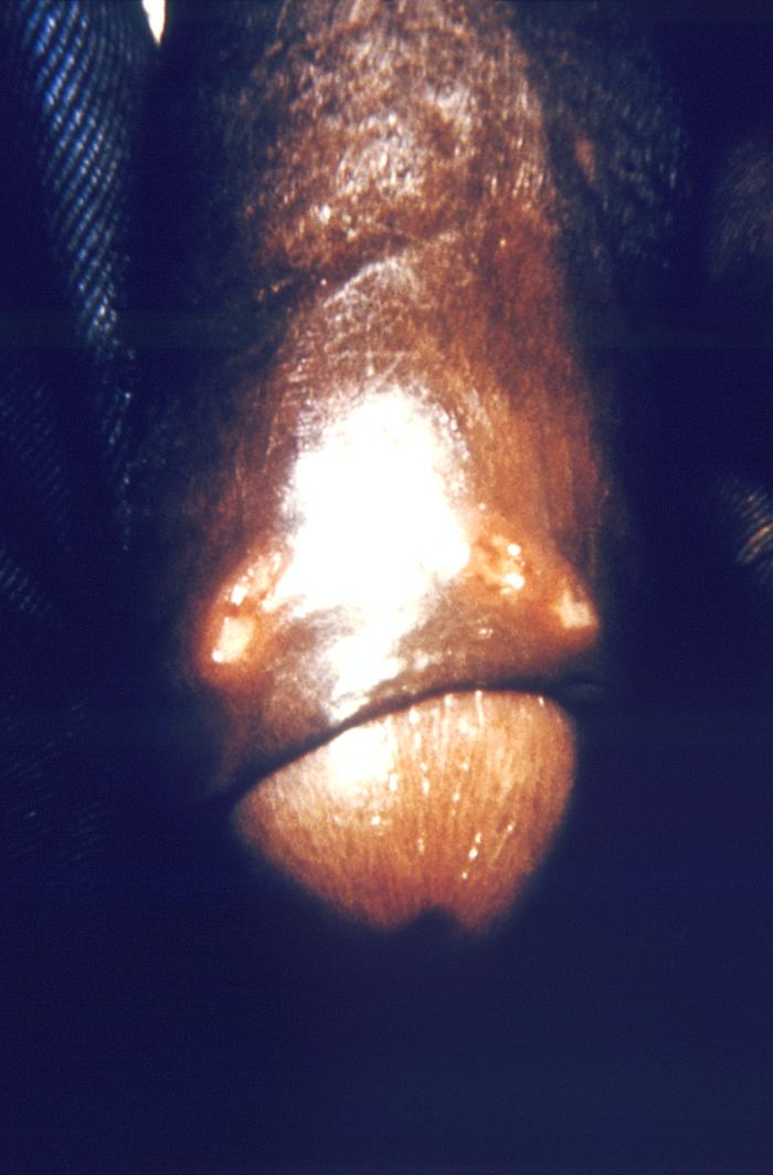 This male patient presented with maculopapular lesions on the distal penile shaft that were first thought to be due to syphilis, but through the process of conducting a differential diagnosis, was later determined to be due to a Herpesviridae infection. Herpes simplex virus, otherwise known as Herpesvirus hominis is a member of a group of viruses including those which cause oral herpes, i.e., usually HSV-1, and genital herpes, i.e., usually HSV-2. Adapted from CDC