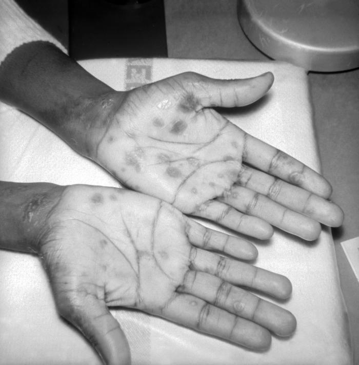 A patient with papulosquamous syphilids, or cutaneous eruptions of the disease, seen here on the wrist and palms. This patient presented with papulosquamous syphilids on the wrist and palms during the secondary stage of syphilis. The rash often appears as rough, red or reddish brown spots and can appear on both the palms of the hands and on the bottoms of the feet. Adapted from CDC