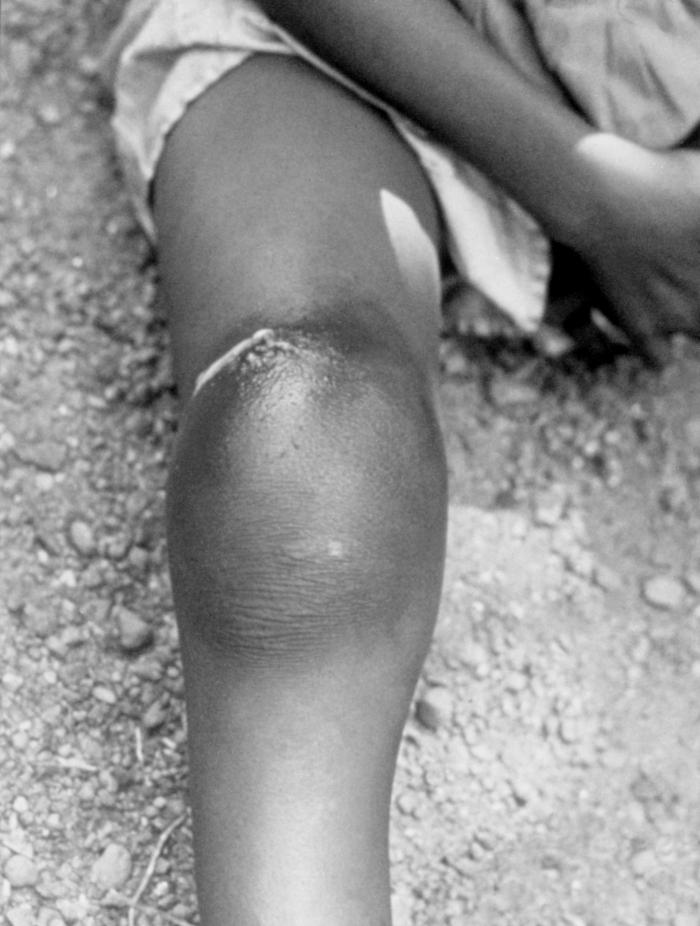 Infection caused by the subcutaneous emergence of an adult female Guinea worm. From Public Health Image Library (PHIL). [8]