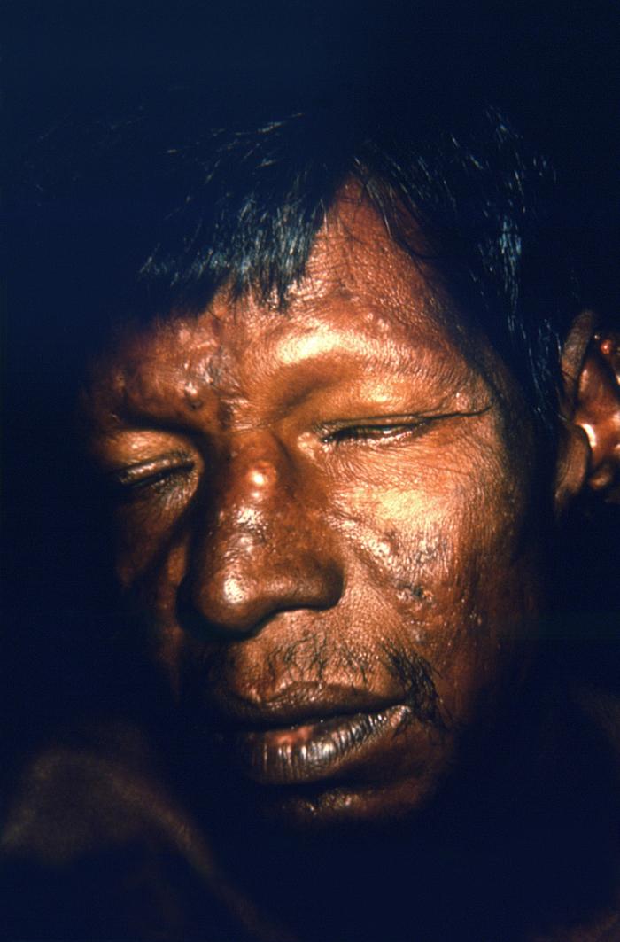 Complications of lepromatous or multibacillary leprosy. Note raised cutaneous nodules on forehead, nose, and cheek. Adapted from Public Health Image Library (PHIL), Centers for Disease Control and Prevention.[6]