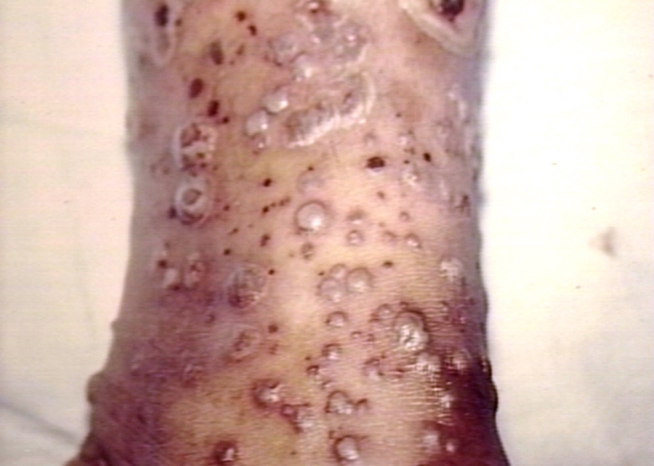 File:Leucocytoclastic vasculitis pustular type.jpg