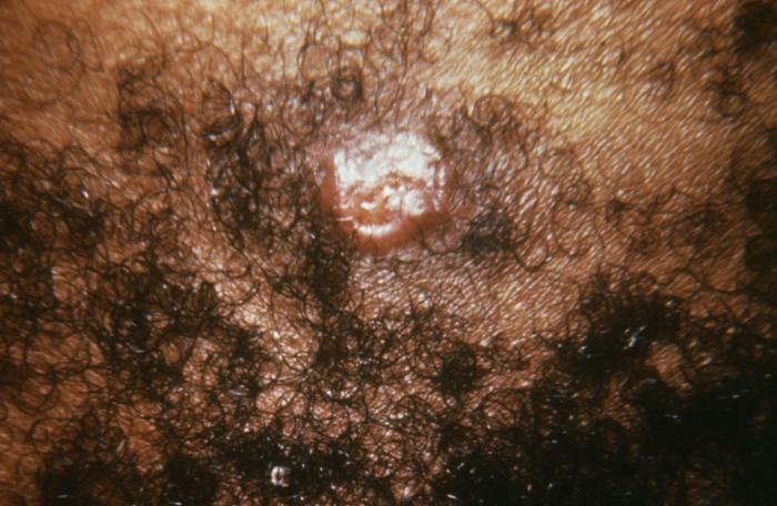 This patient presented with a gonorrheal ecthyma on the skin due to systemically disseminated N. gonorrhoeae bacteria. An ecthyma is a cutaneous eruption consisting of a large, round pustule on an inflamed base caused by untreated gonococcal bacteria spread systemically throughout the bloodstream. Adapted from CDC
