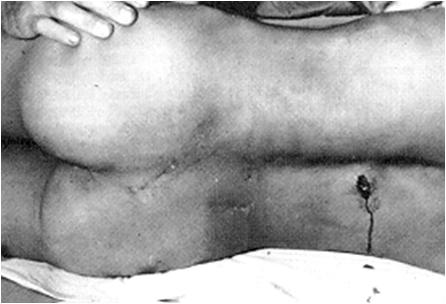 Penetrating abdominal trauma (back)