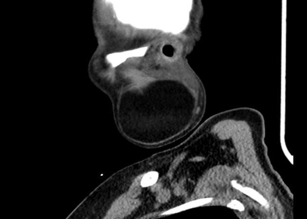 CT showing Sagittal_noncontrast_parotid_lipoma[3]