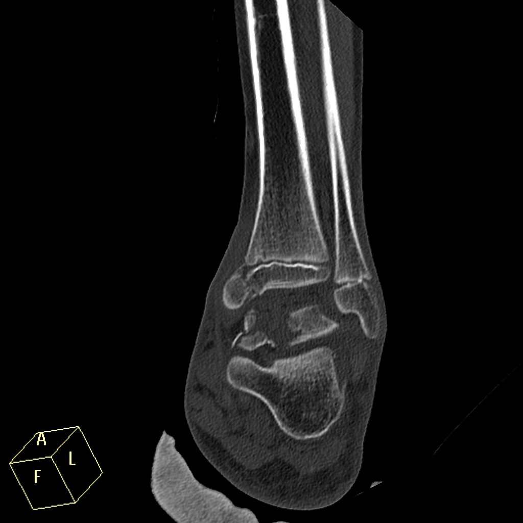File:Salter-Harris type III injury of ankle.jpeg