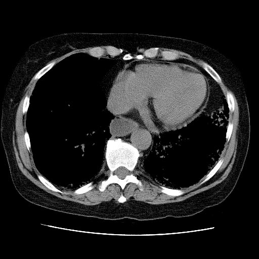 CT:Lung involvement in Scleroderma