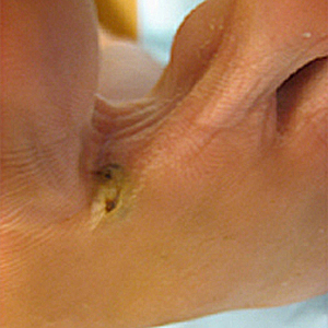 Gross lesion on a patient's foot caused by T. penetrans. Image courtesy of Drs. Mohammed Asmal and Rocio M. Hurtado. Image first appeared at Partners' Infectious Disease Images (http://www.idimages.org), whose content is copyrighted by Partners Healthcare System, Inc., and is used with permission. Adapted from CDC