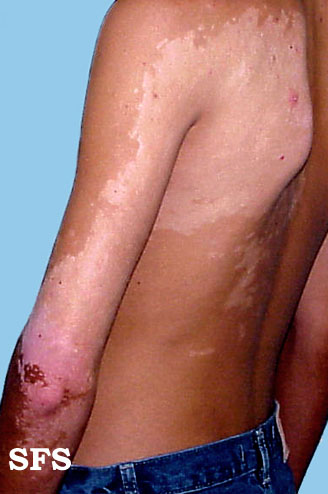 File:Vitiligo 13.jpeg