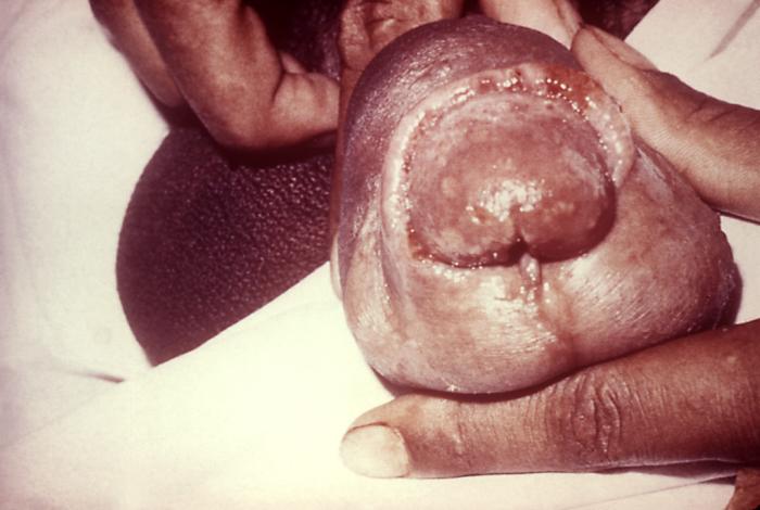 This patient presented with urogenital complications from a case of gonorrhea including penile paraphimosis. Due to the accompanying inflammation brought on by the Neisseria gonorrhoeae infection, the foreskin becomes adherent to the glans penis resulting in a condition known as phimosis, and cannot be retracted in order to expose the entire glans. Adapted from CDC