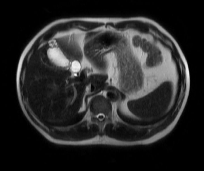 File:Adenomyomatosis MRI 002.jpg