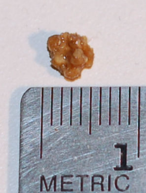 Kidney stone with a maximum dimension of 5mm, Source: Wikimedia commons[8]