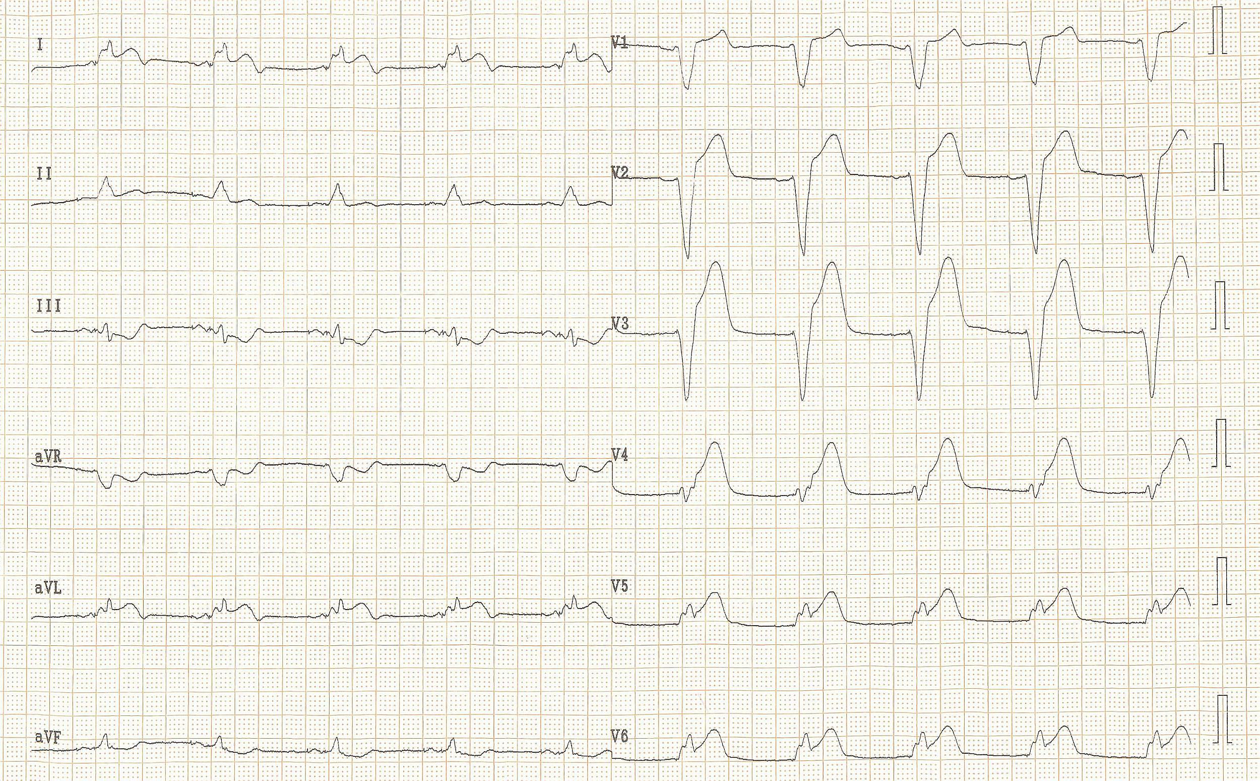 Acute myocardial infarction in in a patient with a pacemaker and LBBB. Concordant ST elevation in V5-V6 are clearly visible. There is discordant ST segment elevation > 5 mm in lead V3.
