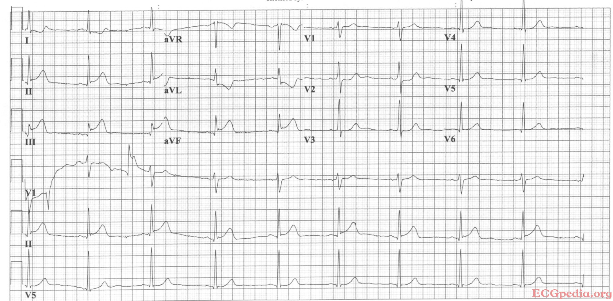 Acute inferoposterior MI: ST elevation in II, III, AVF (in III > II). ST depression in I, AVL, V2. Tall R in V2, otherwise normal QRS morphology.