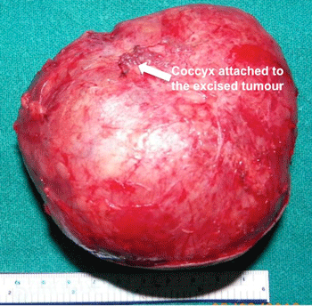 Gross Image of Excised Sacrococcygeal teratoma
