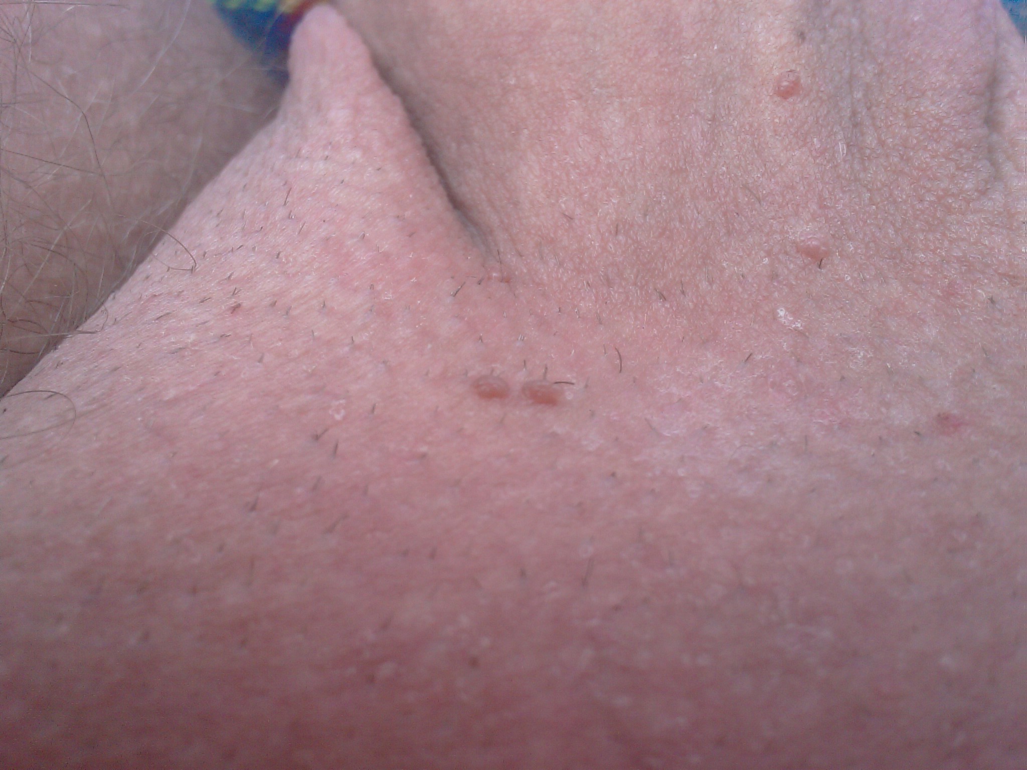 Shaved base of a penis, with genital warts.