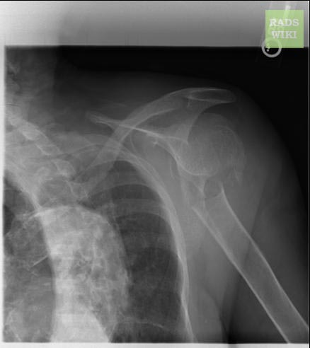 Humeral neck fracture Image courtesy of RadsWiki and copylefted