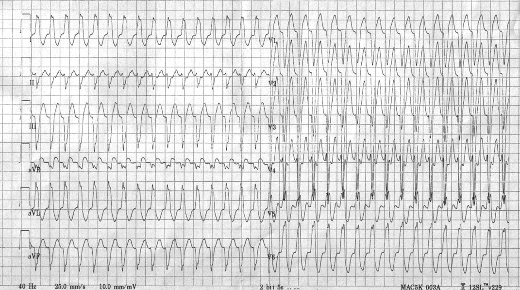 Figure 1: A 24 years old man with Mahaim type of preexcitation