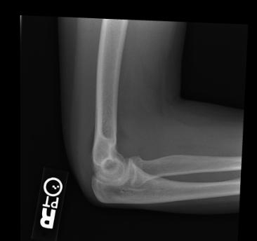 Radiograph demonstrates radial head fracture and joint effusion Image courtesy of RadsWiki and copylefted