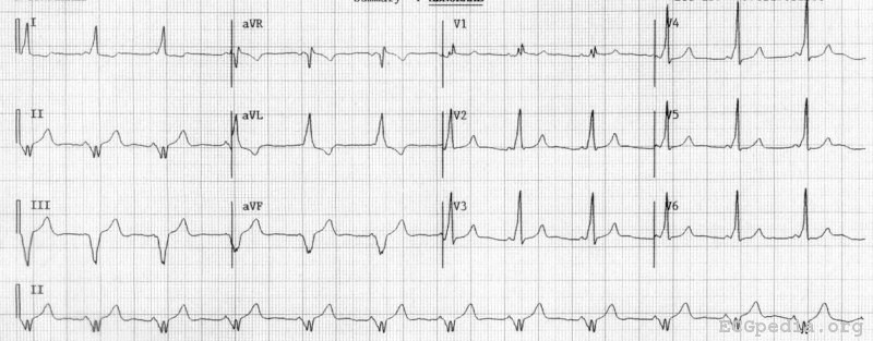 Wolff Parkinson White Syndrome with the characteristic delta wave